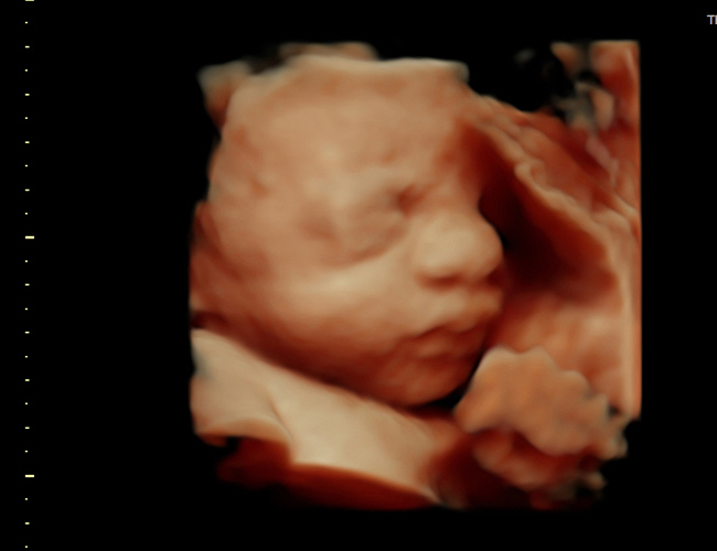 3D ultrasound image at 31 weeks